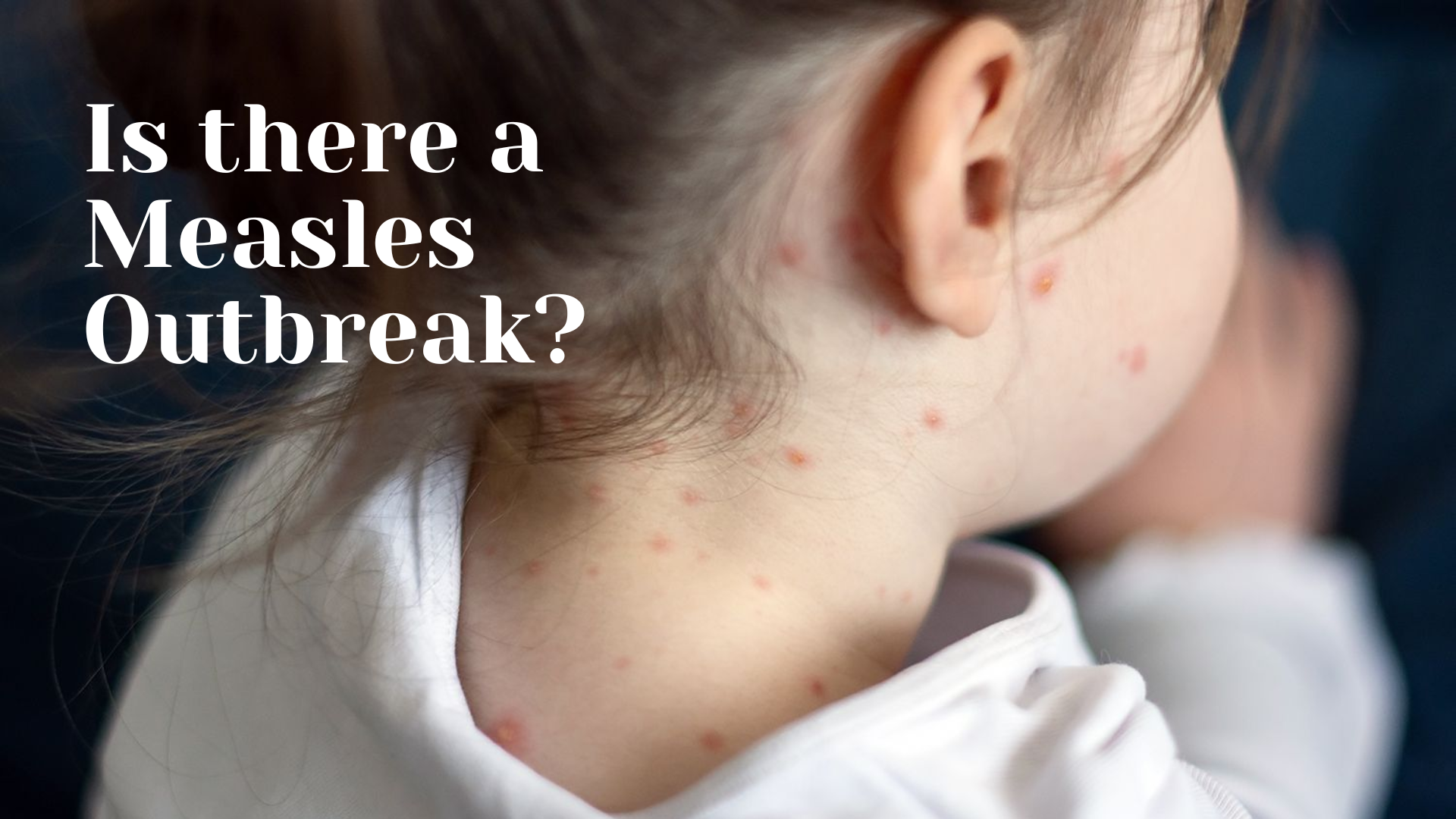 Is there a Measles Outbreak?